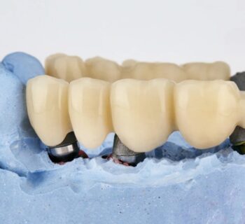 Dental Bridges