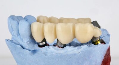 Dental Bridges