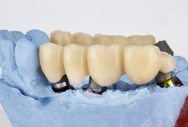 Dental Bridges